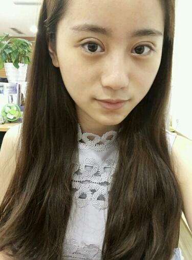 割雙眼皮案例圖片 雙眼皮手術(shù)20天