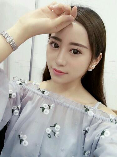 割雙眼皮案例圖片 雙眼皮手術(shù)20天