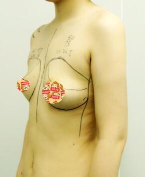 自體脂肪豐胸恢復正常需要多久 我的經(jīng)歷告訴你