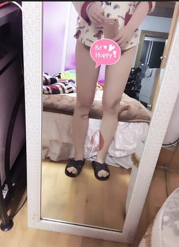 自體脂肪豐胸恢復正常需要多久 我的經(jīng)歷告訴你