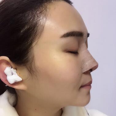 上海余天成二次鼻修復(fù)恢復(fù)日記 隆鼻整形修復(fù)+下巴吸脂