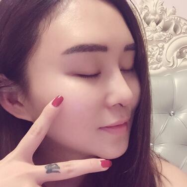 上海余天成二次鼻修復(fù)恢復(fù)日記 隆鼻整形修復(fù)+下巴吸脂