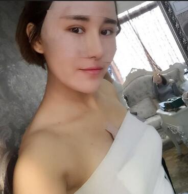 上海余天成自體脂肪隆胸70天恢復(fù)經(jīng)歷