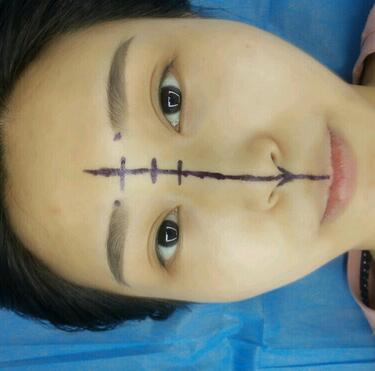 上海澳雅鼻小柱鼻中隔延長(zhǎng)+耳軟骨鼻尖2個(gè)月的照片