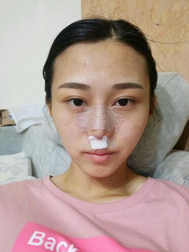 上海澳雅鼻小柱鼻中隔延長(zhǎng)+耳軟骨鼻尖2個(gè)月的照片