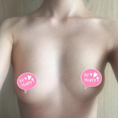 武漢詮美曼托假體隆胸半年啦~