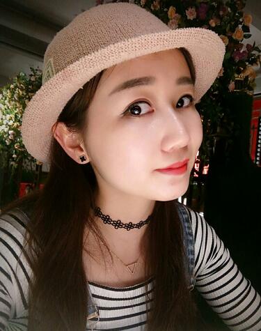 上海九院林曉曦割雙眼皮半年了