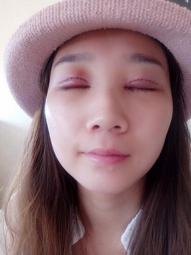 上海九院林曉曦割雙眼皮半年了