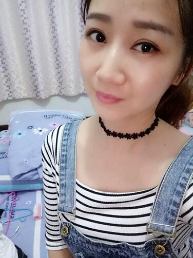 上海九院林曉曦割雙眼皮半年了