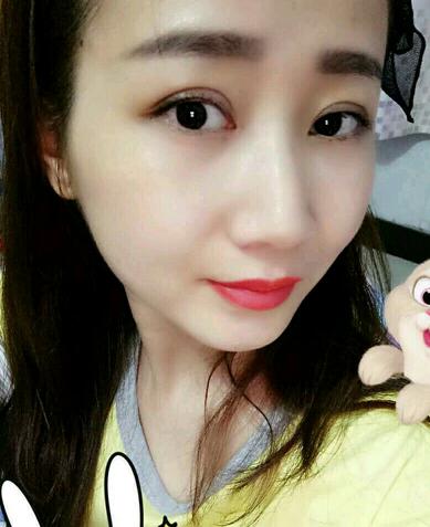 上海九院林曉曦割雙眼皮半年了