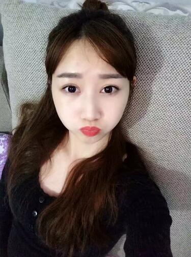 上海九院林曉曦割雙眼皮半年了