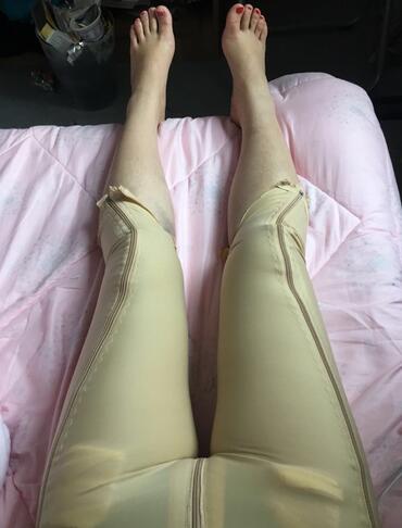 上海九院曹衛(wèi)剛大腿抽脂后恢復(fù)圖