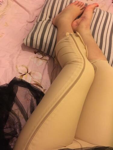 上海九院曹衛(wèi)剛大腿抽脂后恢復(fù)圖