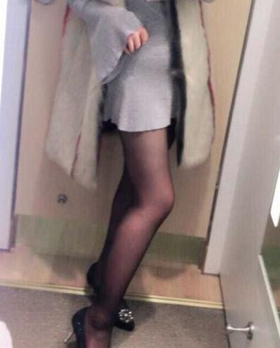 上海九院曹衛(wèi)剛大腿抽脂后恢復(fù)圖