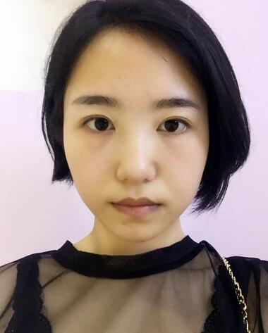武漢憶美凱德去眼袋手術(shù)后兩個月照片