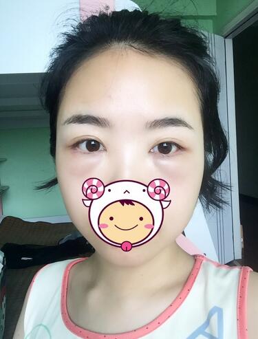 武漢憶美凱德去眼袋手術(shù)后兩個月照片