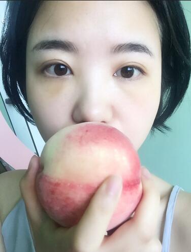 武漢憶美凱德去眼袋手術(shù)后兩個月照片