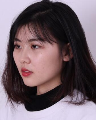 武漢西嬋康美玻尿酸隆鼻恢復(fù)過程圖