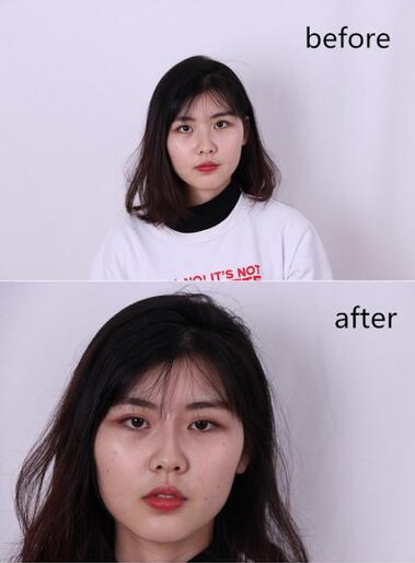 武漢西嬋康美玻尿酸隆鼻恢復(fù)過程圖