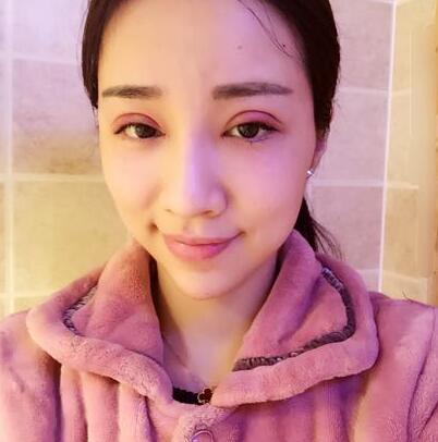 切開雙眼皮恢復(fù)過程分享 杭州東方做雙眼皮2個(gè)月