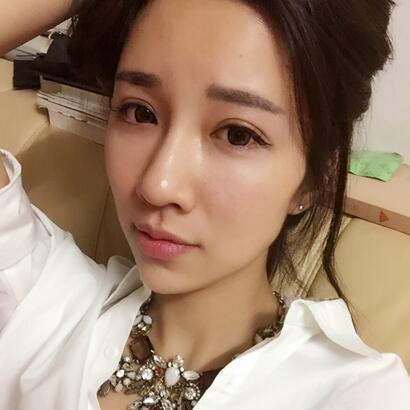 切開雙眼皮恢復(fù)過程分享 杭州東方做雙眼皮2個(gè)月