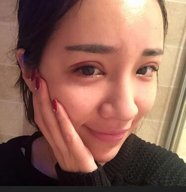 切開雙眼皮恢復(fù)過程分享 杭州東方做雙眼皮2個(gè)月