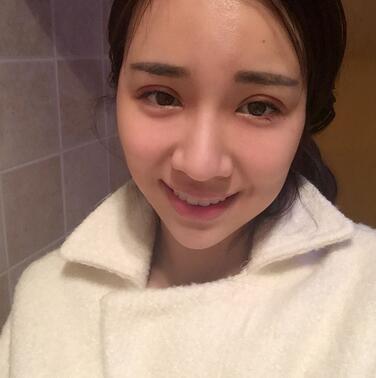 切開雙眼皮恢復(fù)過程分享 杭州東方做雙眼皮2個(gè)月