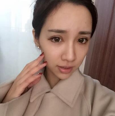 切開雙眼皮恢復(fù)過程分享 杭州東方做雙眼皮2個(gè)月