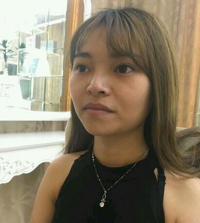 隆鼻整形真實(shí)恢復(fù)期圖片 杭州東方隆鼻整形四個(gè)月