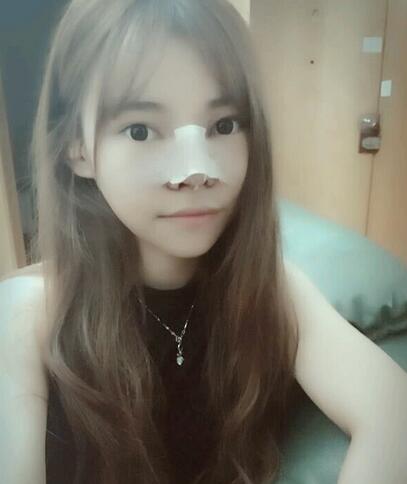 隆鼻整形真實(shí)恢復(fù)期圖片 杭州東方隆鼻整形四個(gè)月