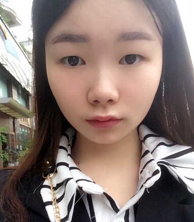 八大處楊明勇做的雙眼皮 半年了