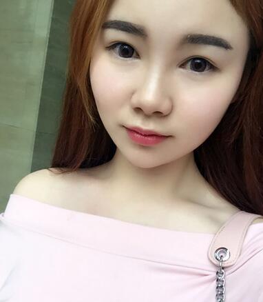 八大處楊明勇做的雙眼皮 半年了