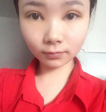 八大處楊明勇做的雙眼皮 半年了