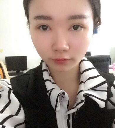 八大處楊明勇做的雙眼皮 半年了