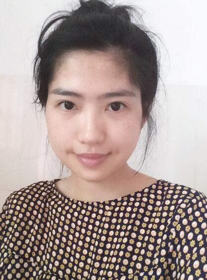 北京八大處下頜角截骨前后果對比