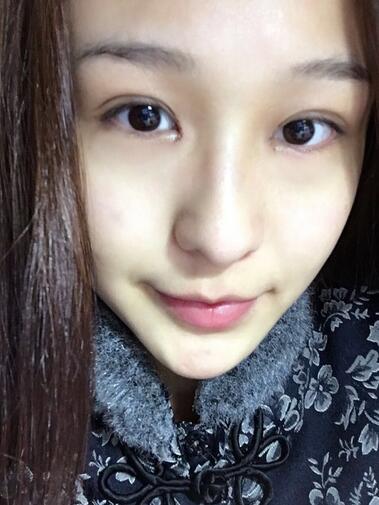 杭州大麥微針龍都整形開(kāi)眼角+割雙眼皮恢復(fù)記錄