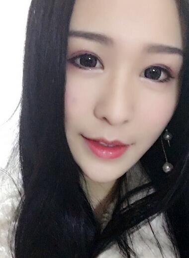 杭州大麥微針龍都整形開(kāi)眼角+割雙眼皮恢復(fù)記錄