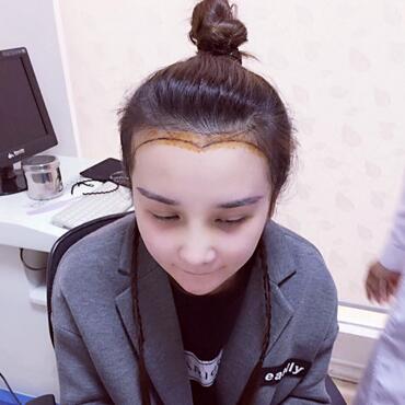 發(fā)際線調(diào)整果對(duì)比圖 杭州大麥微針龍都發(fā)際線種植