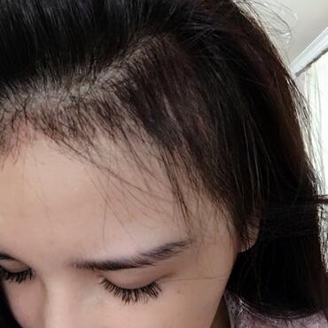 發(fā)際線調(diào)整果對(duì)比圖 杭州大麥微針龍都發(fā)際線種植