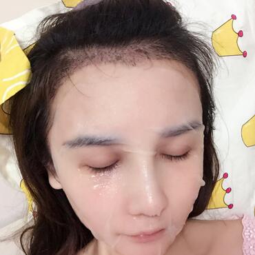 發(fā)際線調(diào)整果對(duì)比圖 杭州大麥微針龍都發(fā)際線種植