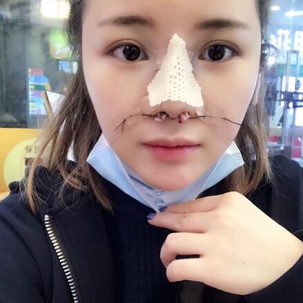 北京八大處李戰(zhàn)強(qiáng)隆鼻案例