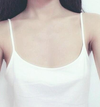 北京八大處穆大力假體隆胸2個(gè)月