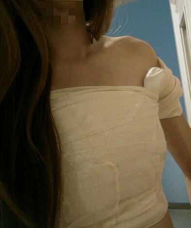 北京八大處穆大力假體隆胸2個(gè)月