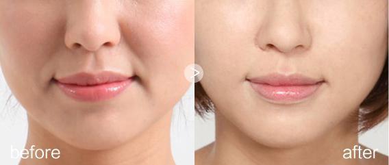 上海注射注射除皺價(jià)格是多少