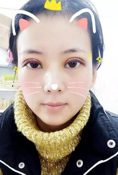 北京八大處辛敏強(qiáng)做雙眼皮怎么樣 案例分享