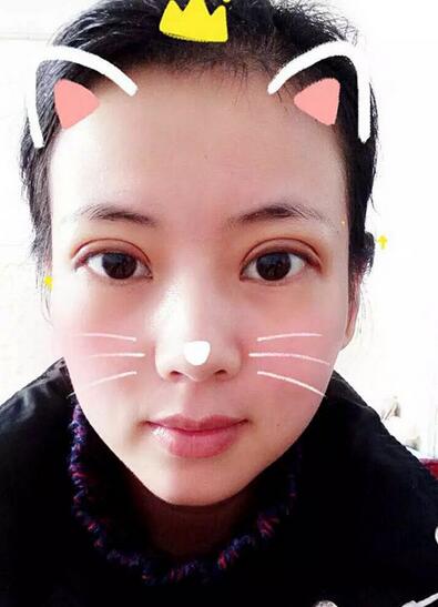 北京八大處辛敏強(qiáng)做雙眼皮怎么樣 案例分享