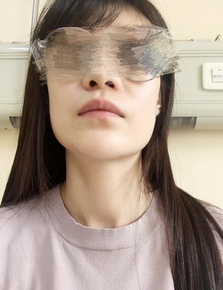 北京葉子磨下頜角整形的果圖