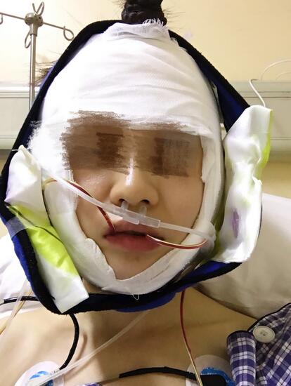 北京葉子磨下頜角整形的果圖