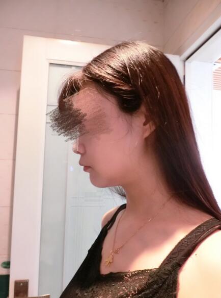 北京葉子磨下頜角整形的果圖