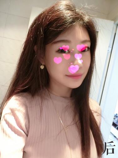 北京葉子磨下頜角整形的果圖